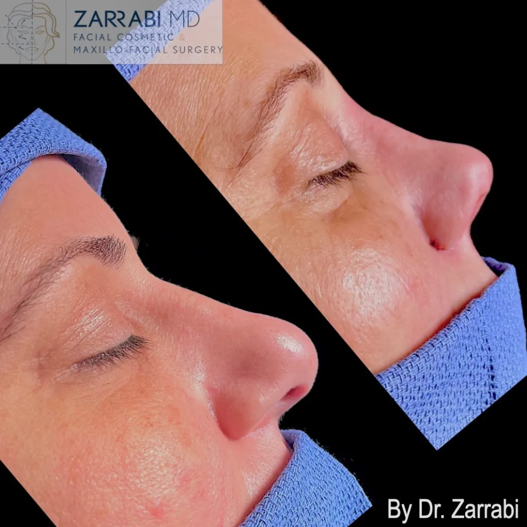Closed Ultrasonic Rhinoplasty 2 11