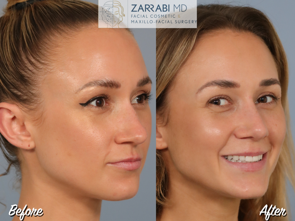 Closed Ultrasonic Rhinoplasty 2 12