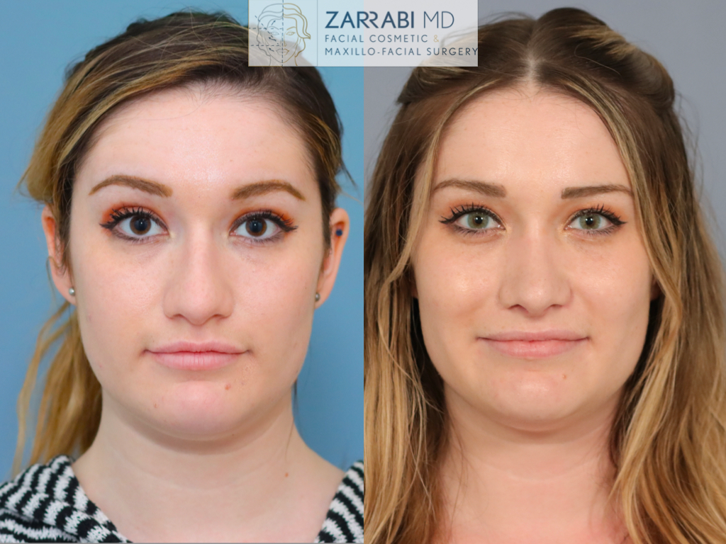 Closed Ultrasonic Rhinoplasty 2 13