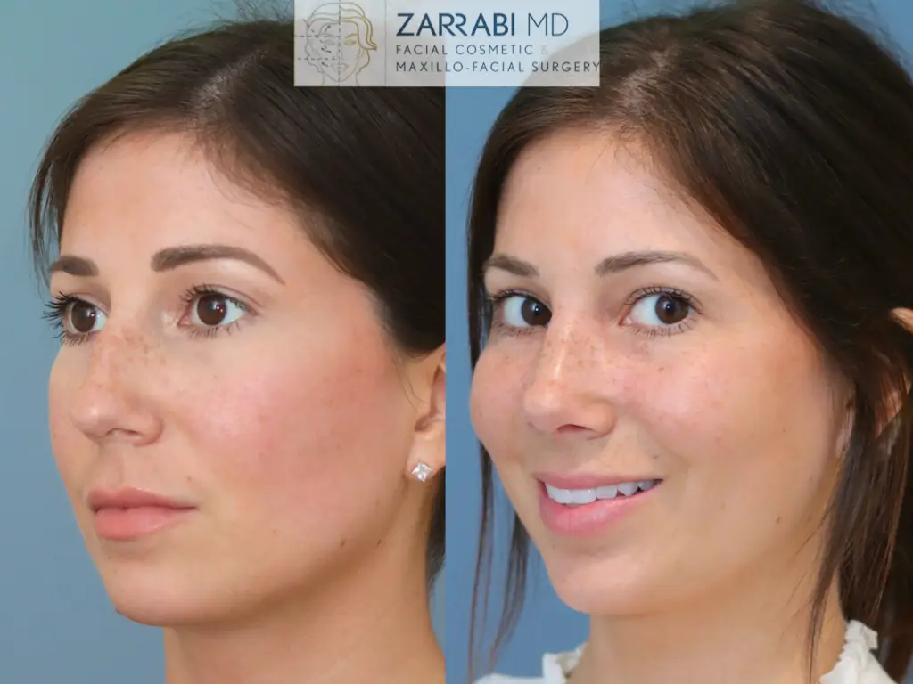 Closed-Ultrasonic-Rhinoplasty-2-14