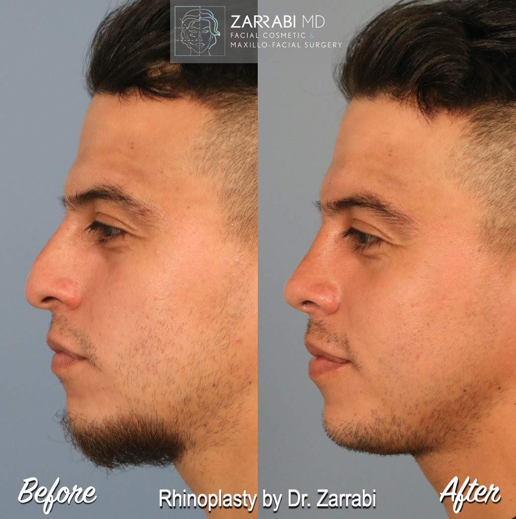 Closed Ultrasonic Rhinoplasty 2 2