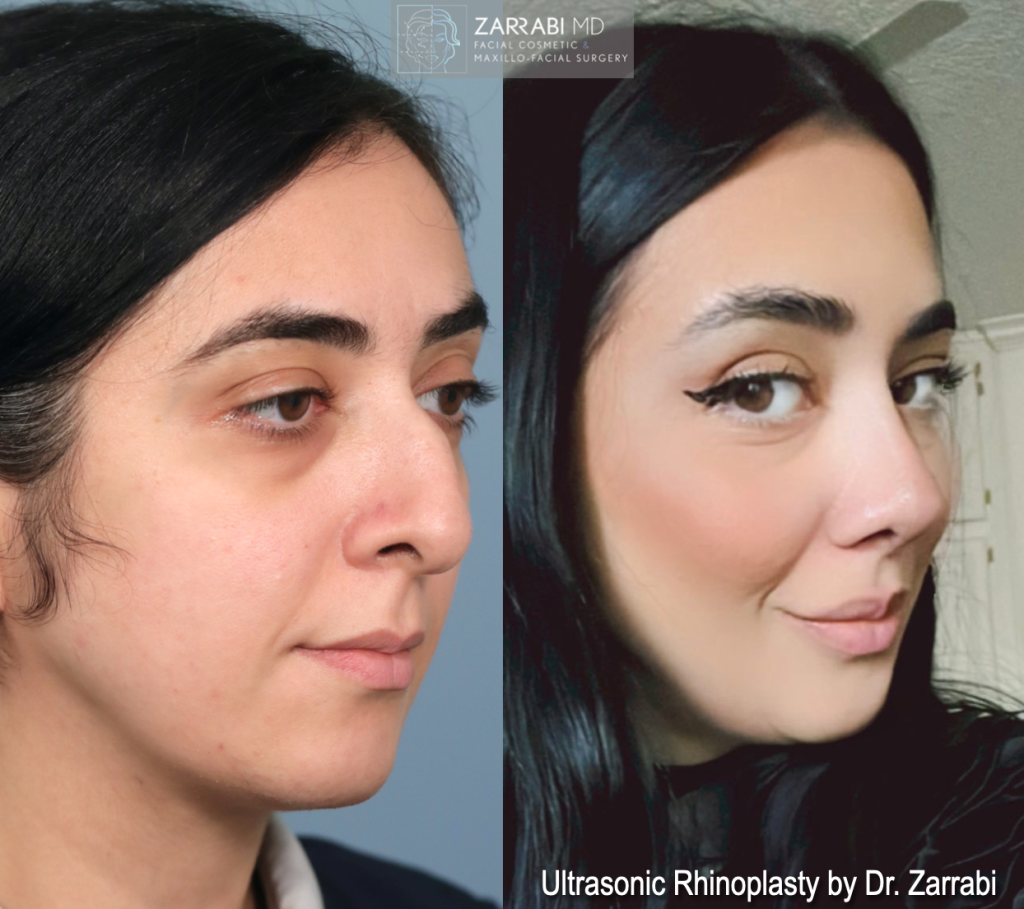 Closed Ultrasonic Rhinoplasty 2 4