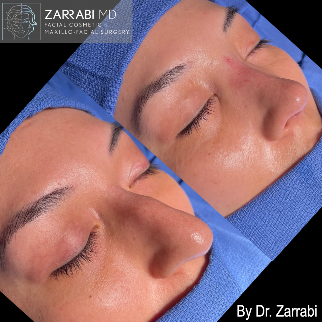Closed Ultrasonic Rhinoplasty 2 5