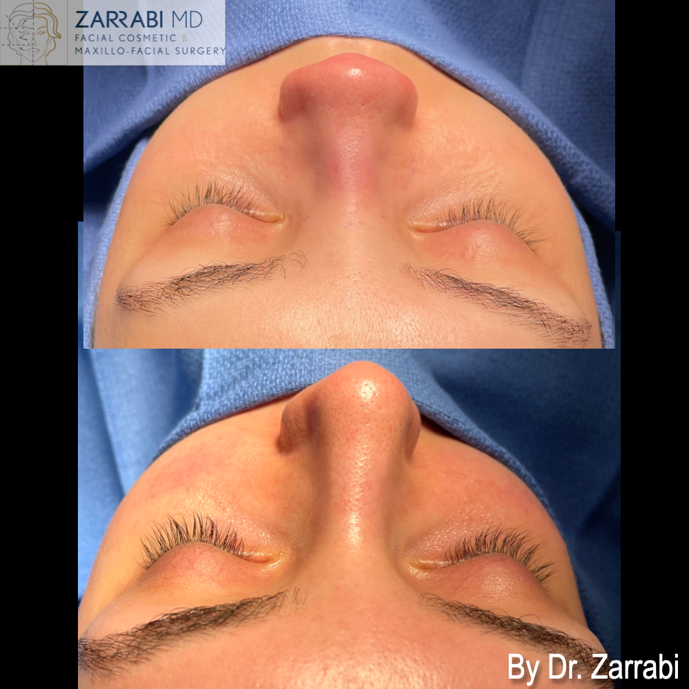 Closed Ultrasonic Rhinoplasty 2 9