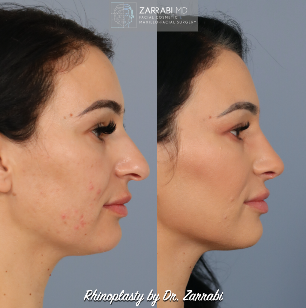 Closed Ultrasonic Rhinoplasty 3 1