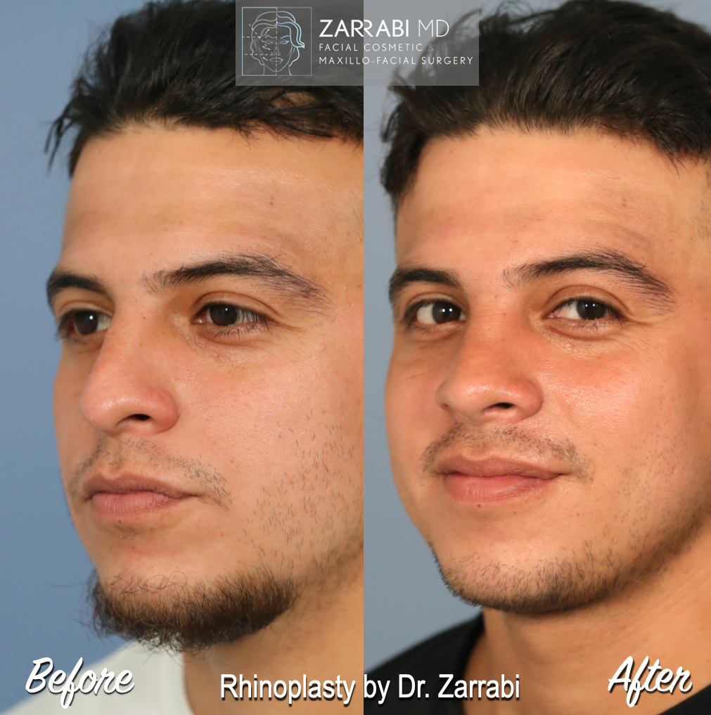 Closed Ultrasonic Rhinoplasty 3 2