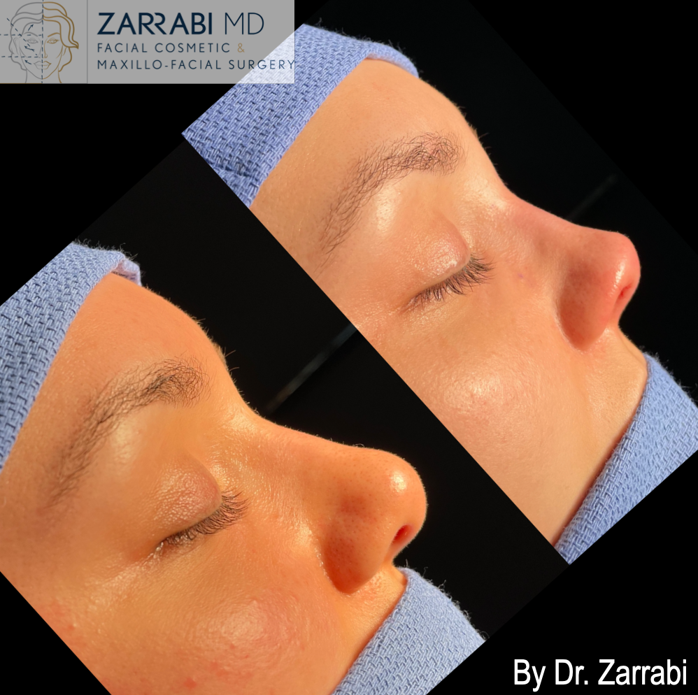 Closed Ultrasonic Rhinoplasty 3 5