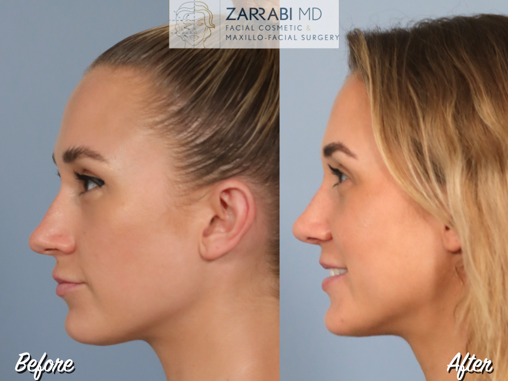 Closed Ultrasonic Rhinoplasty 3 7