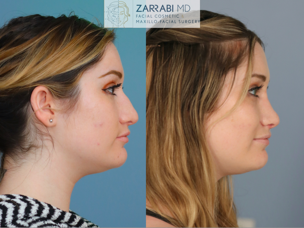 Closed Ultrasonic Rhinoplasty 3 8