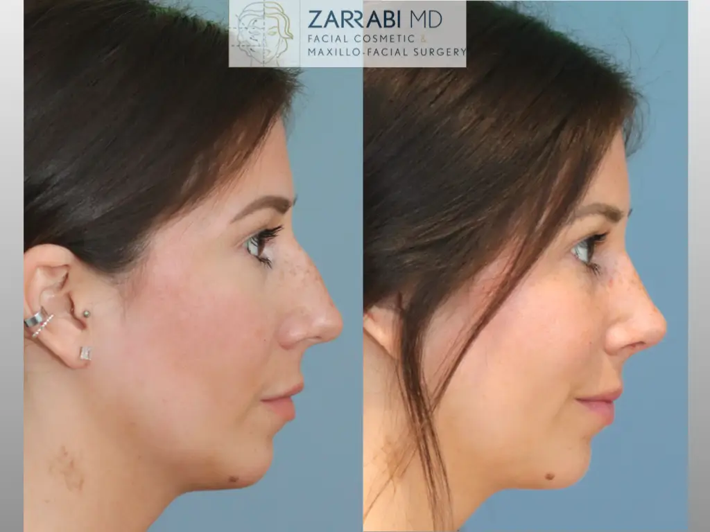 Closed-Ultrasonic-Rhinoplasty-3-9