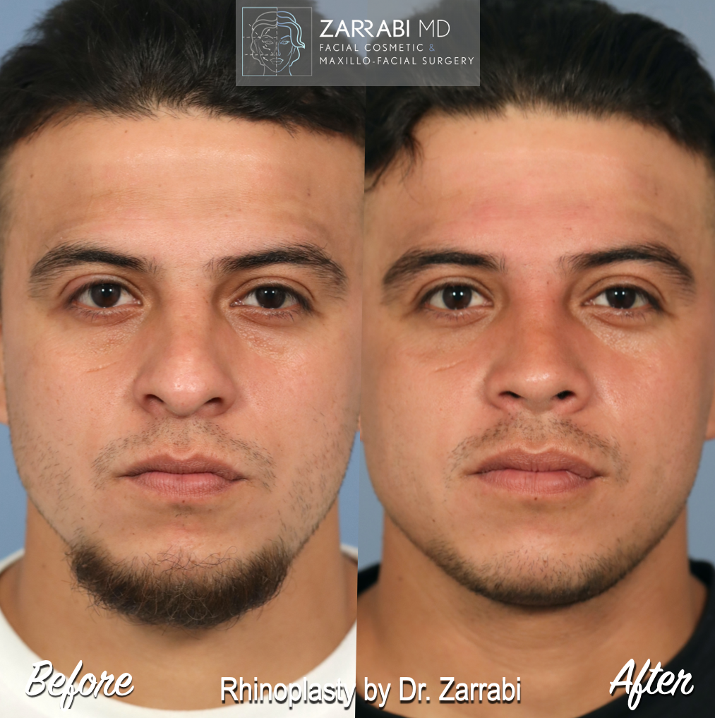 Closed Ultrasonic Rhinoplasty 4 2