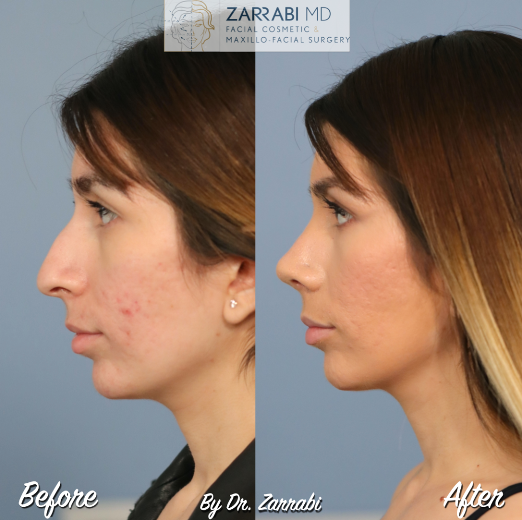 Closed Ultrasonic Rhinoplasty 4 5