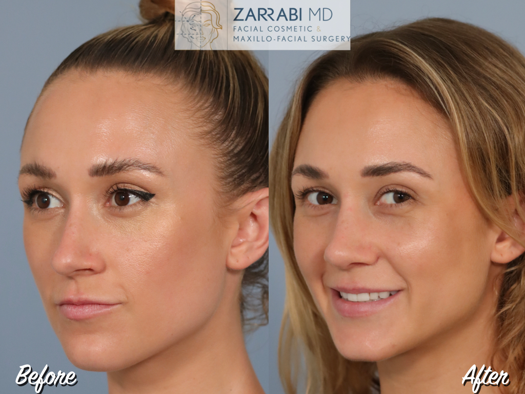 Closed Ultrasonic Rhinoplasty 4 6