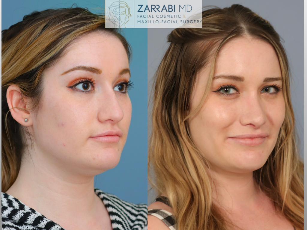 Closed Ultrasonic Rhinoplasty 4 7