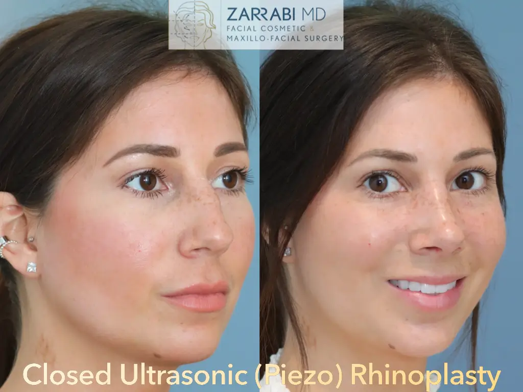 Closed-Ultrasonic-Rhinoplasty-5-8