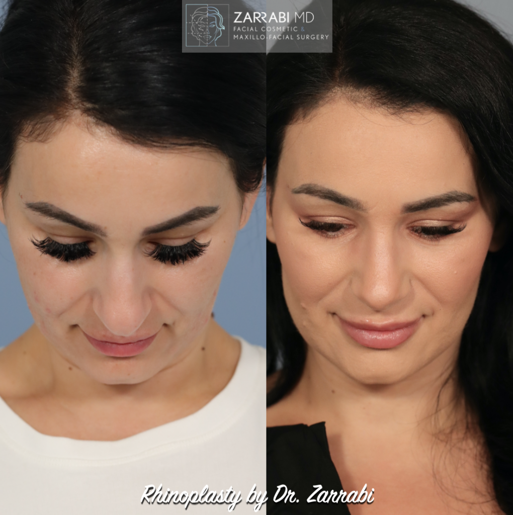 Closed Ultrasonic Rhinoplasty 5 1