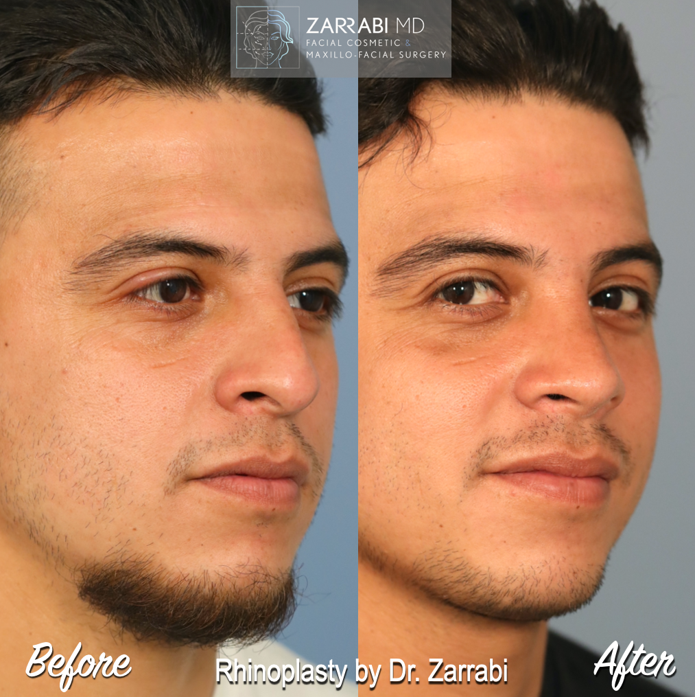 Closed Ultrasonic Rhinoplasty 5 2