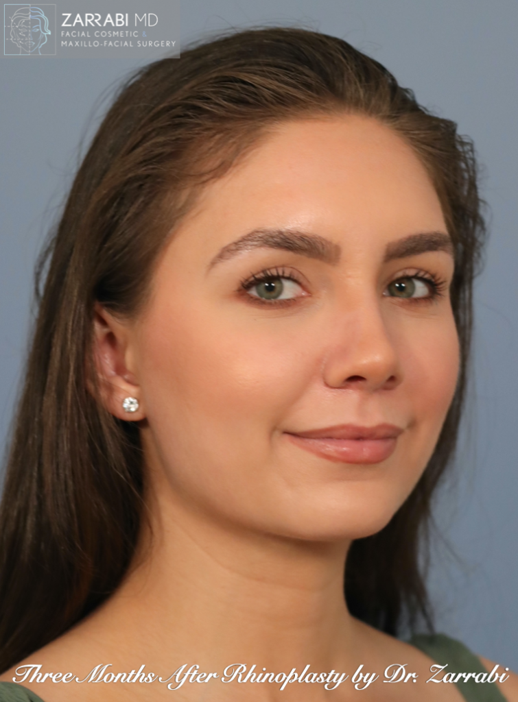 Closed Ultrasonic Rhinoplasty 5 4