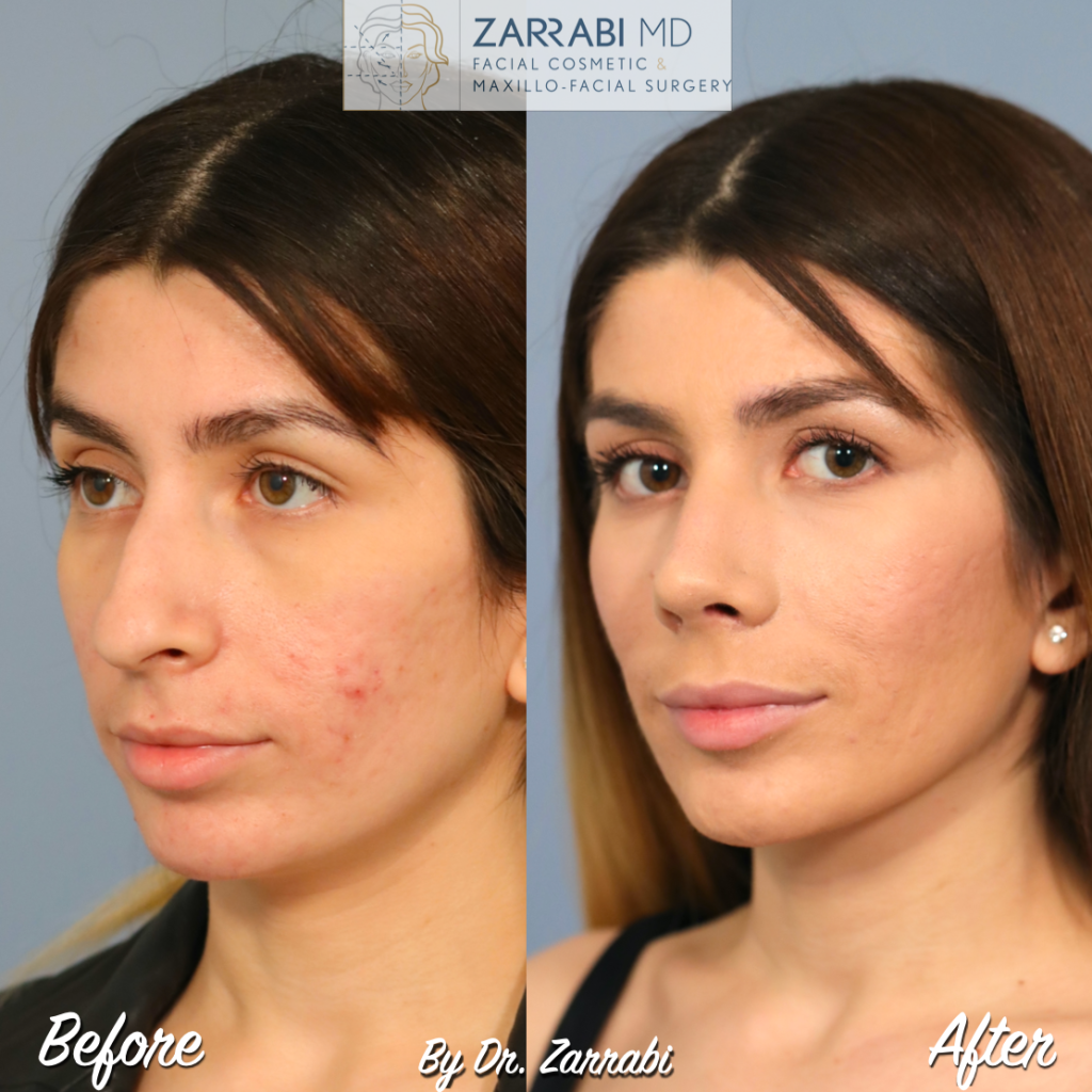 Closed Ultrasonic Rhinoplasty 5 5