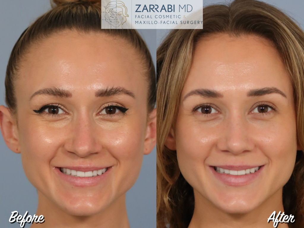 Closed Ultrasonic Rhinoplasty 5 6