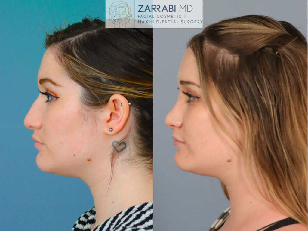 Closed Ultrasonic Rhinoplasty 5 7