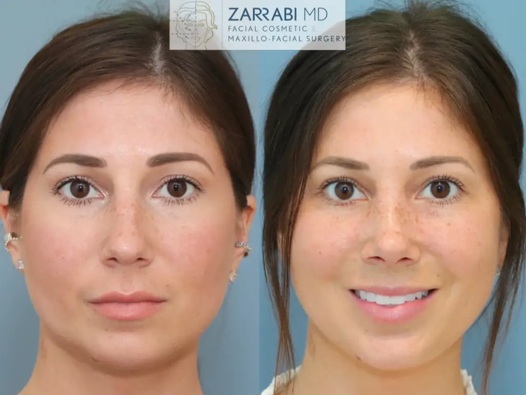 Closed-Ultrasonic-Rhinoplasty-5-8