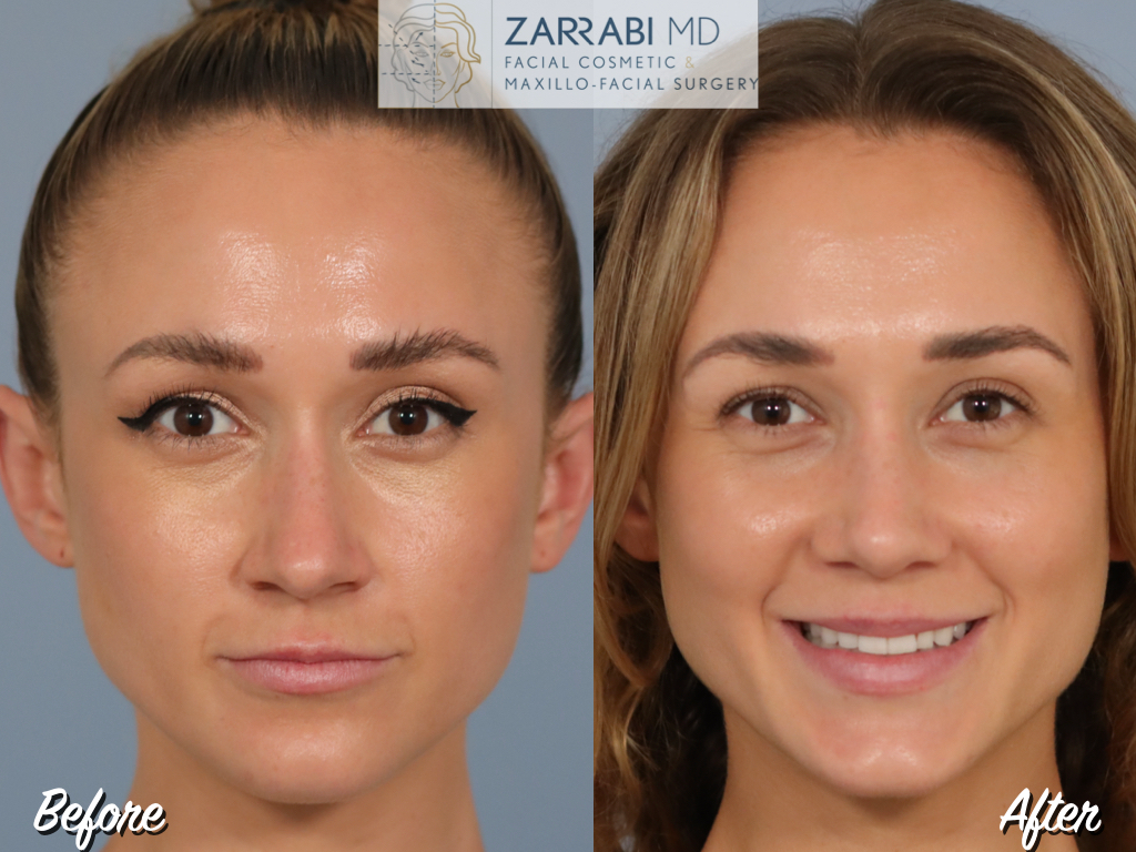 Closed Ultrasonic Rhinoplasty 6 1