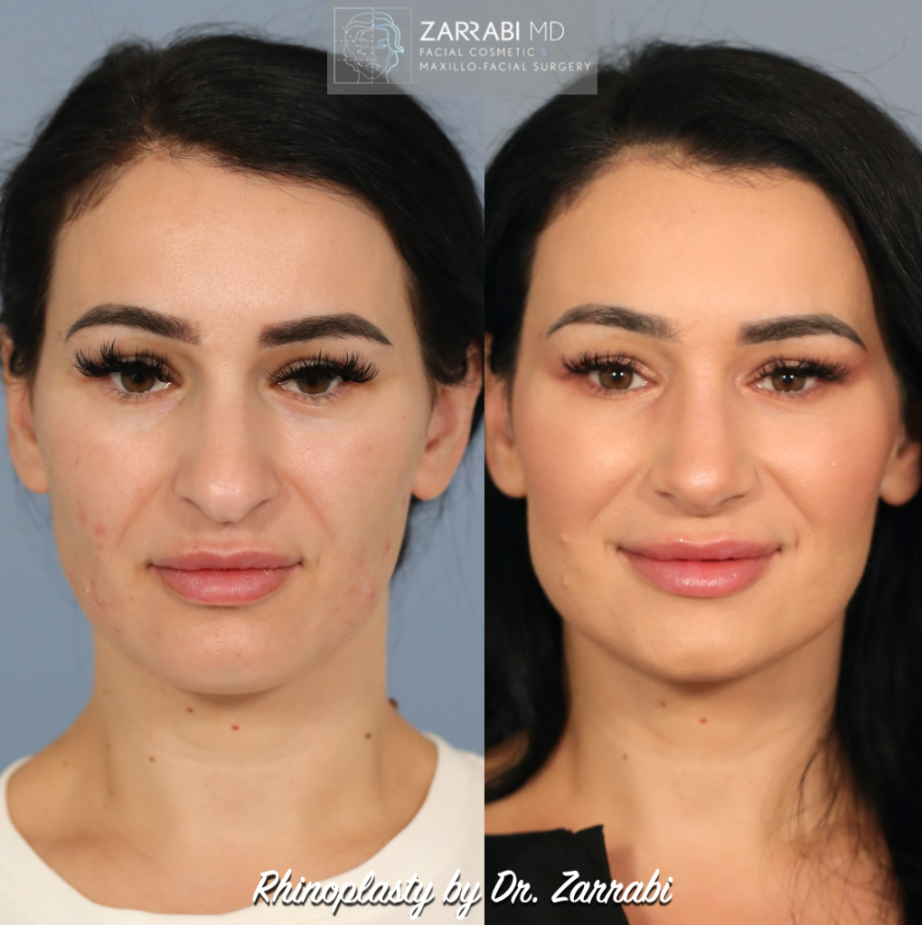 Closed Ultrasonic Rhinoplasty 6