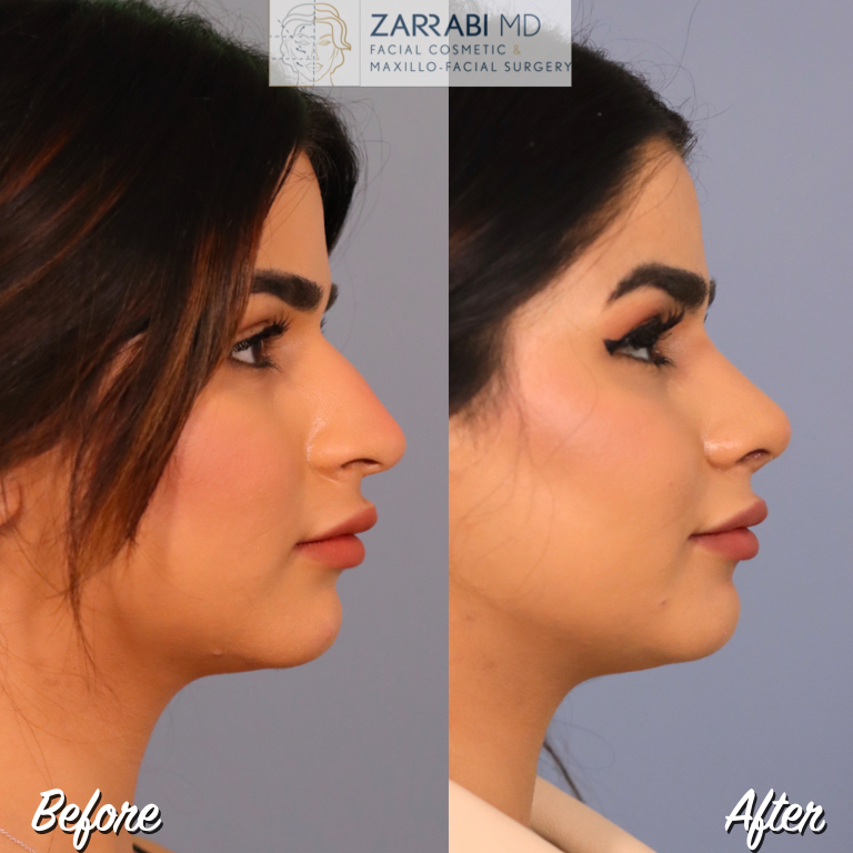 Closed Ultrasonic Rhinoplasty Before After 1
