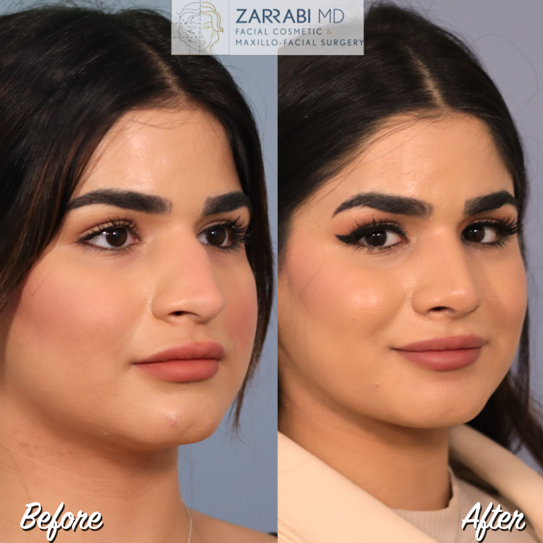 Closed Ultrasonic Rhinoplasty Before After 2