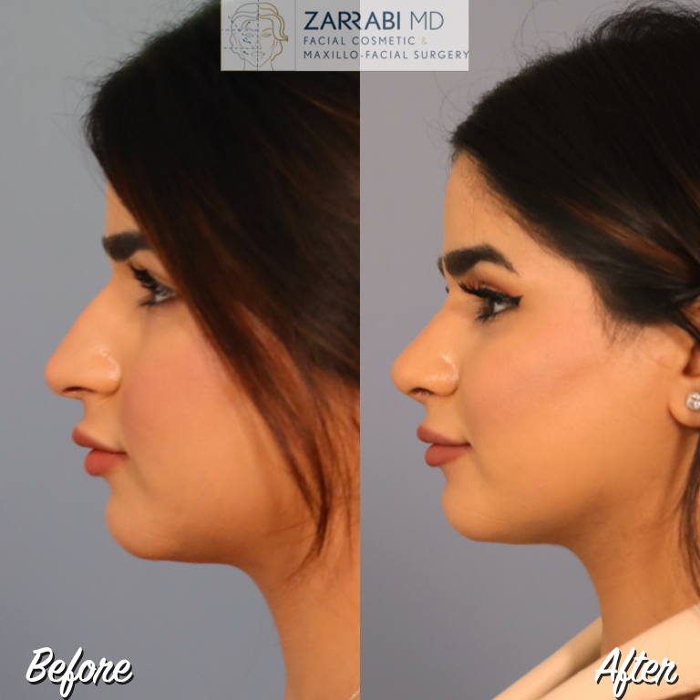 Closed Ultrasonic Rhinoplasty Before After 3