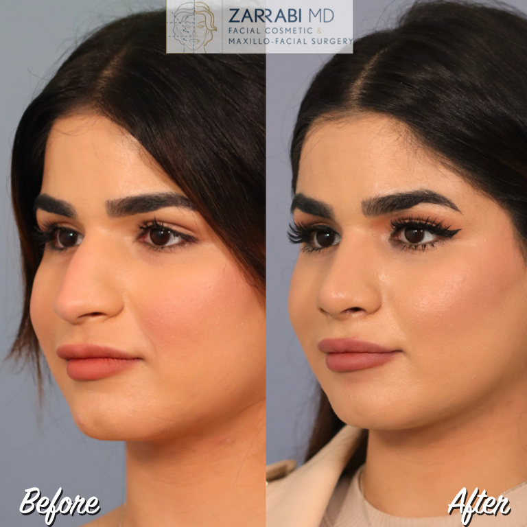 Closed Ultrasonic Rhinoplasty Before After 4