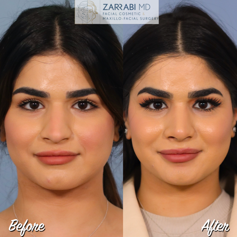 Closed Ultrasonic Rhinoplasty Before After 5