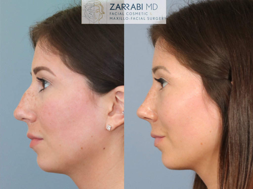 Closed Ultrasonic Rhinoplasty Seven Weeks Post Op 1
