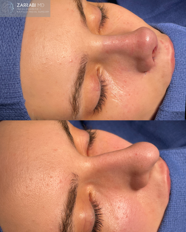 Piezo Ultrasonic Rhinoplasty 3 3