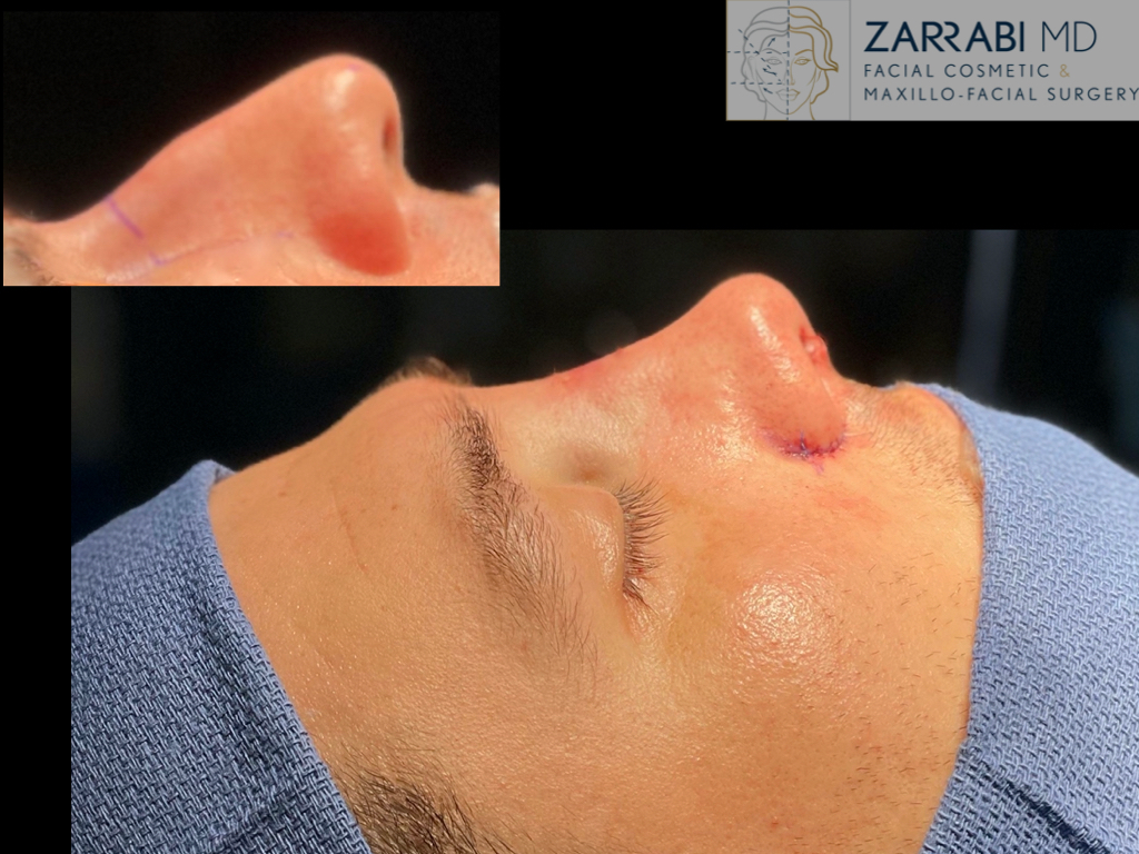 Preservation Rhinoplasty 1 1