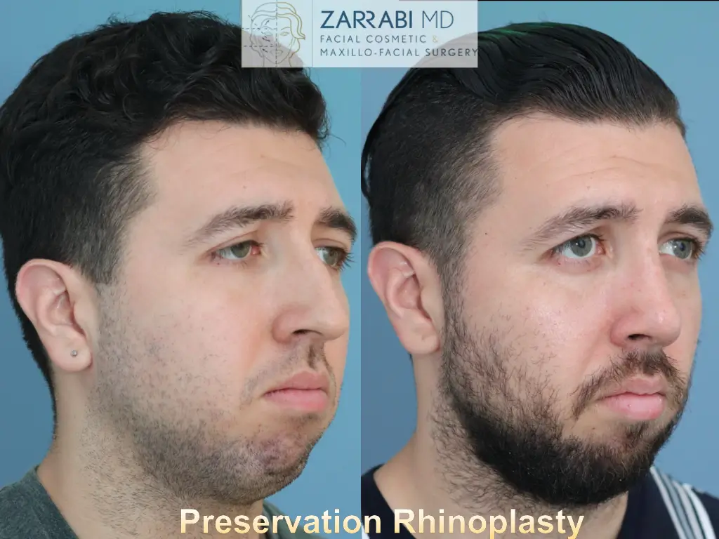 Preservation-Rhinoplasty-1