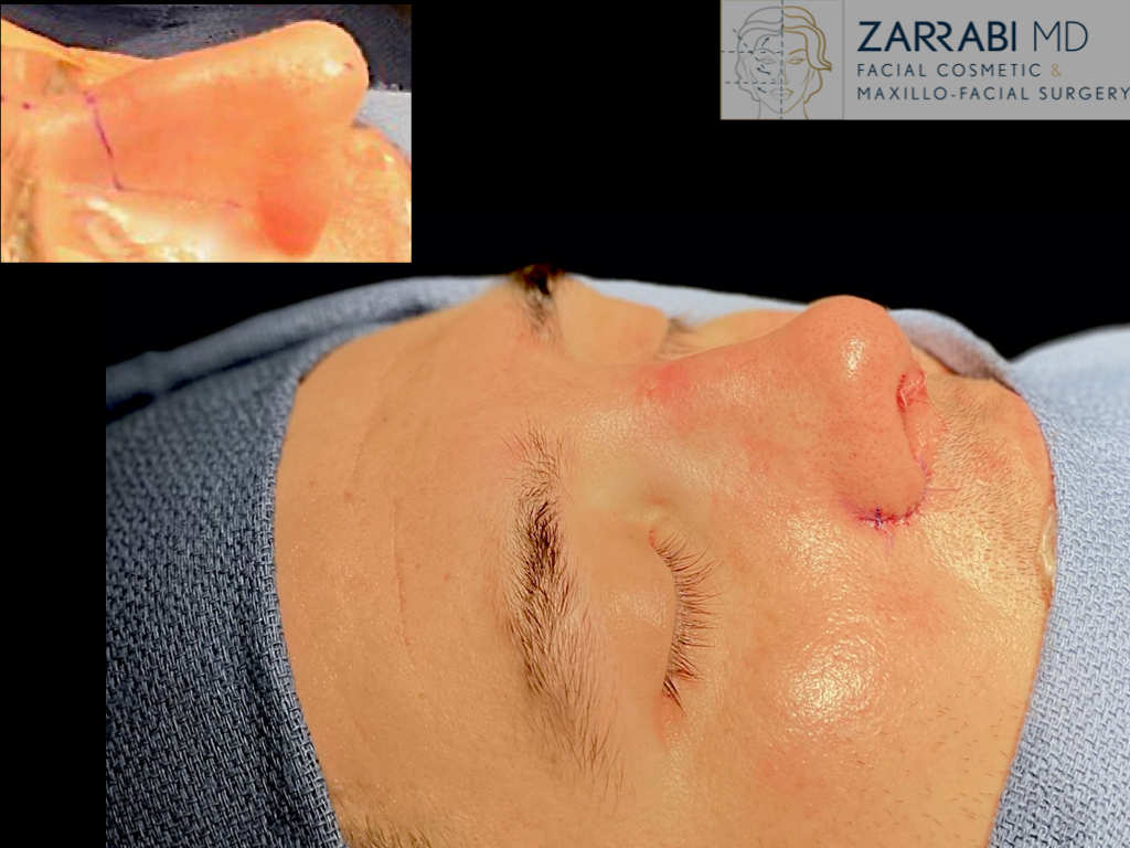 Preservation Rhinoplasty 2 1