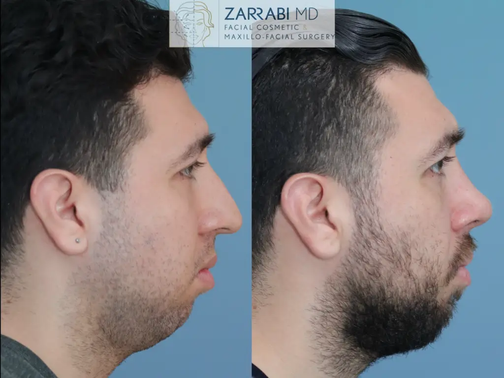 Preservation-Rhinoplasty-4