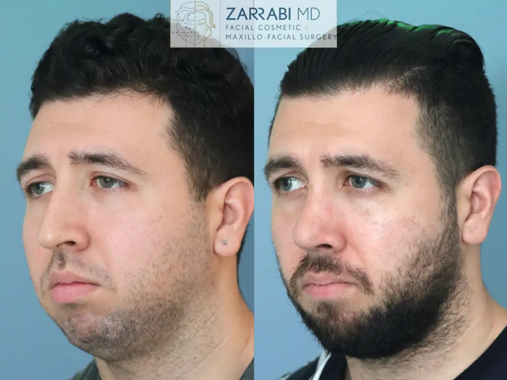 Preservation-Rhinoplasty-5