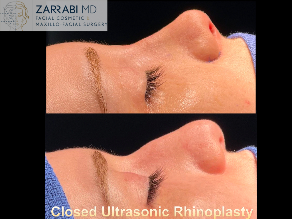 Rhinoplasty 1