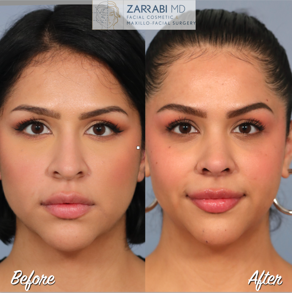 Rhinoplasty Before After 1 1