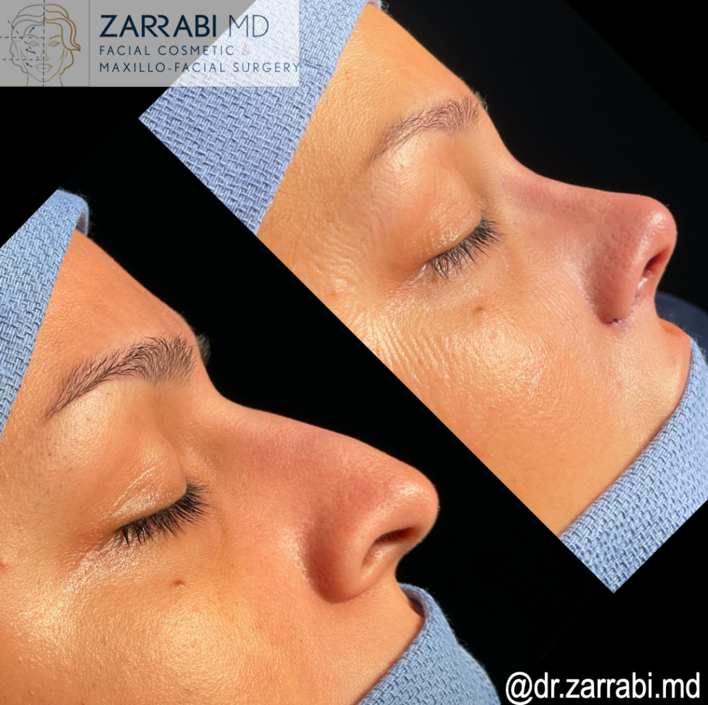 Rhinoplasty Before After 1 2