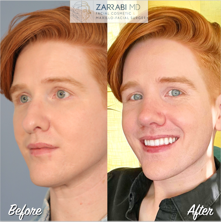 Rhinoplasty Before After 1