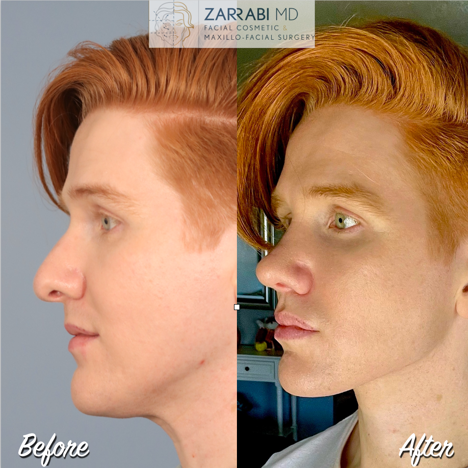 Rhinoplasty Before After 2