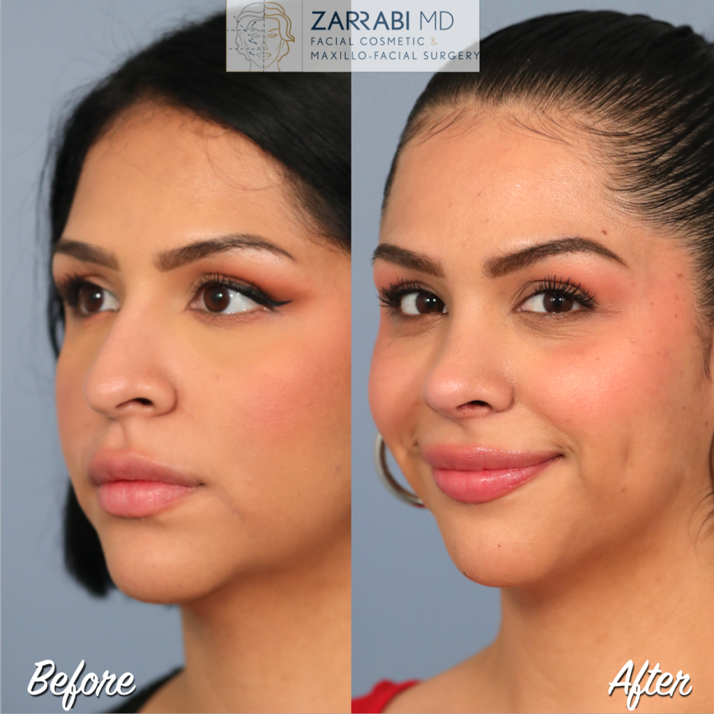 Rhinoplasty Before After 5