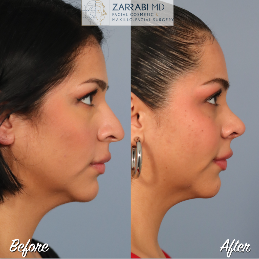 Rhinoplasty Before After 6