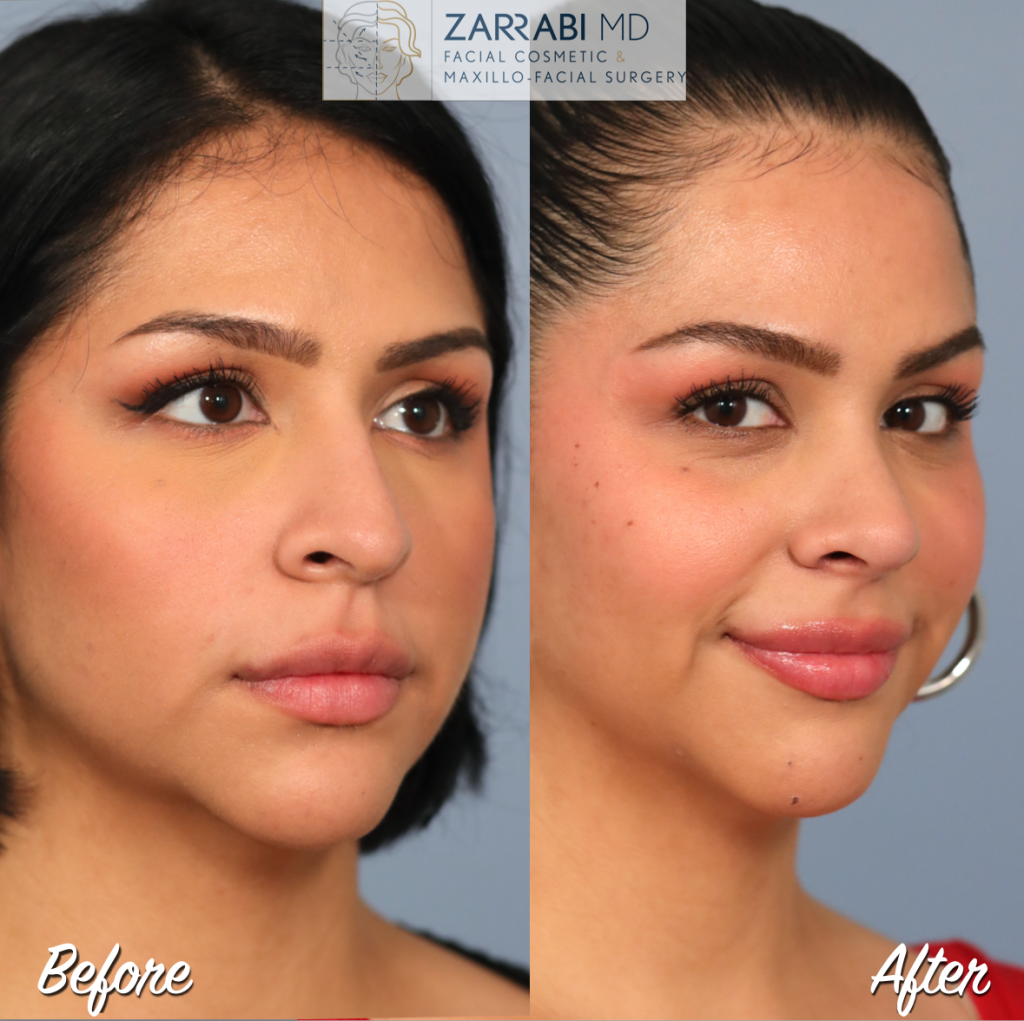 Rhinoplasty Before After 7