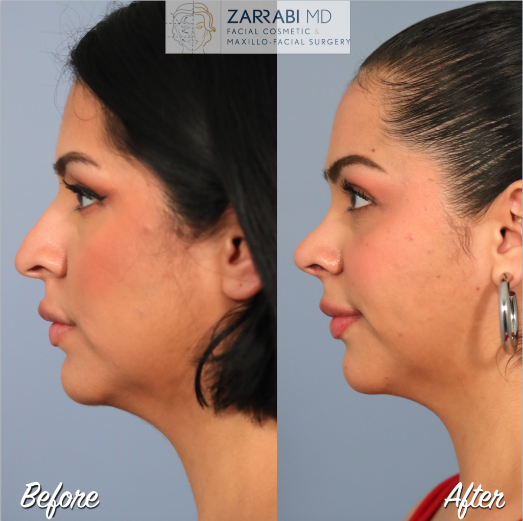 Rhinoplasty Before After 8