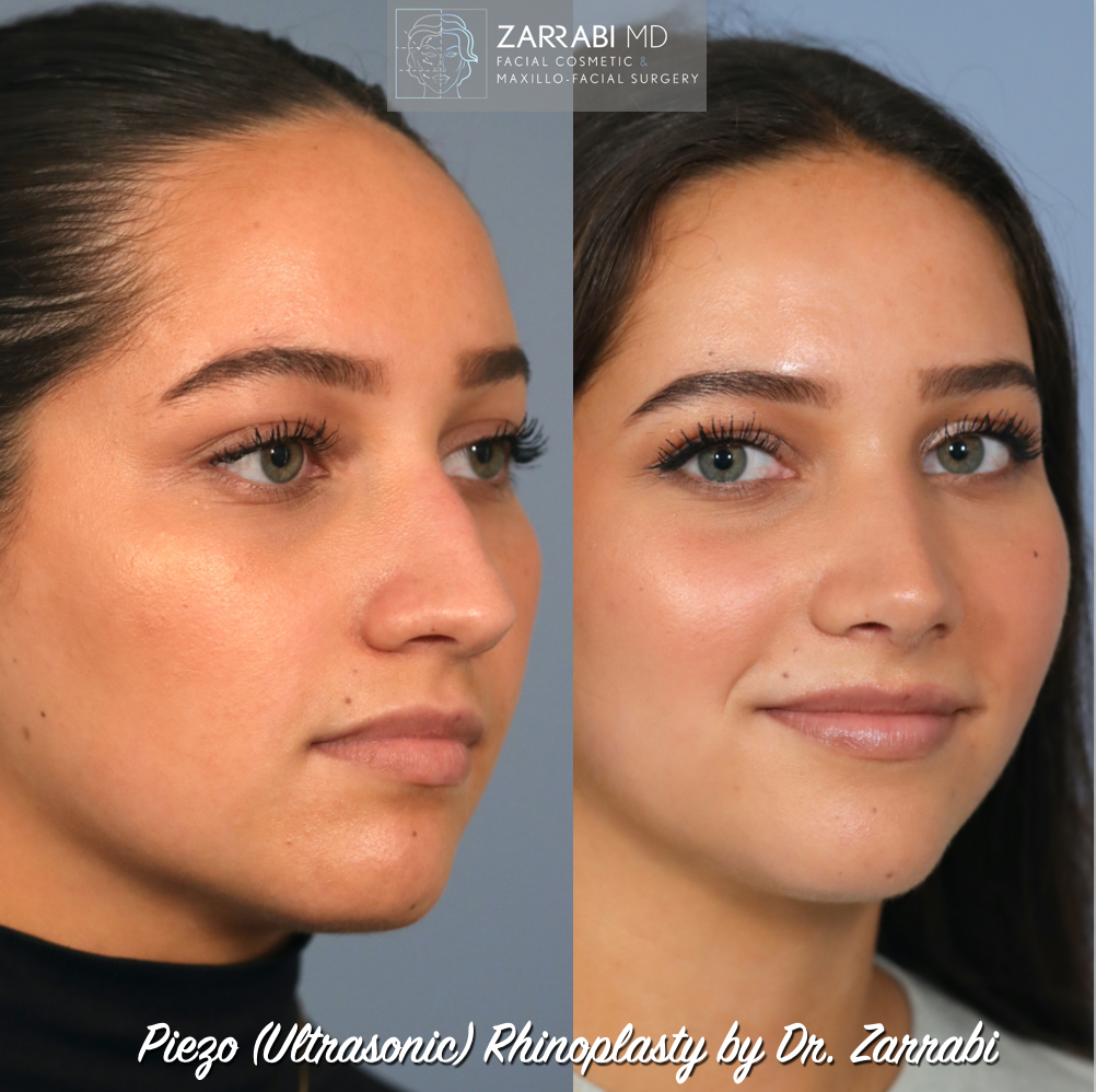 Ultrasonic Piezo Rhinoplasty 1